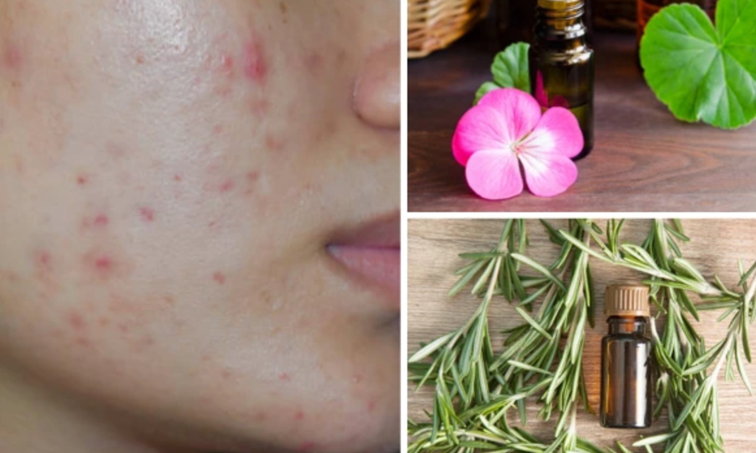 Six Essential Oils for Acne-Prone Skin: How to Use Them Without Clogging Pores